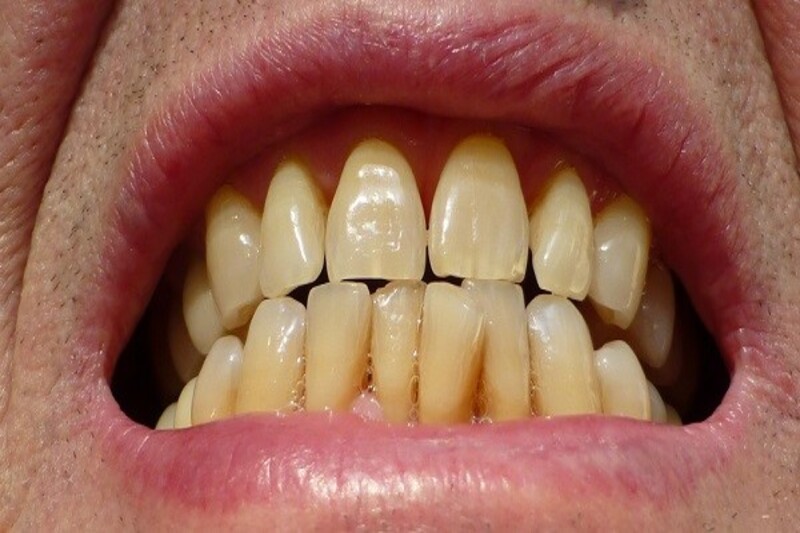 Decoloración del diente: Endodoncia