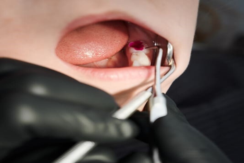 Una fractura dental  Endodoncia