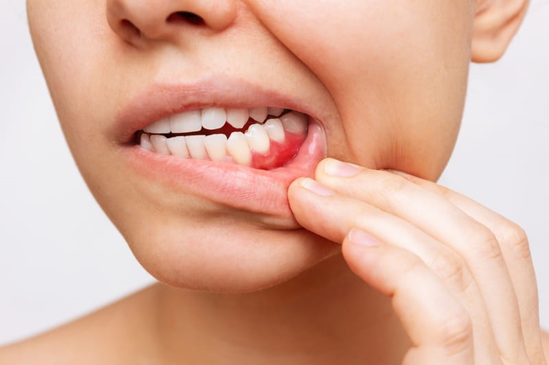 Hinchazón o absceso dental. Endodoncia